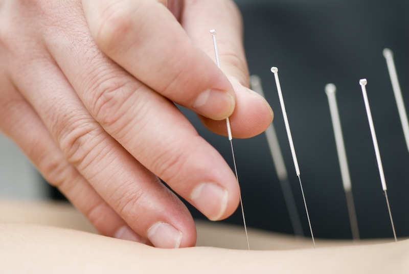 acupuncture needles